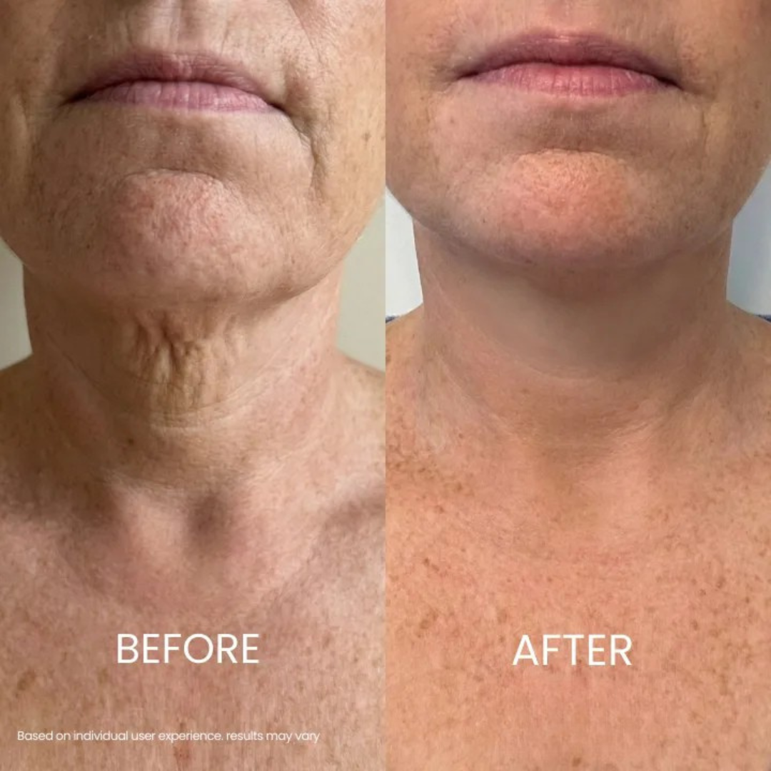 Elastyn® Tighten & Lift Neck Cream